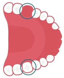 Trường hợp chỉ định trồng răng implant